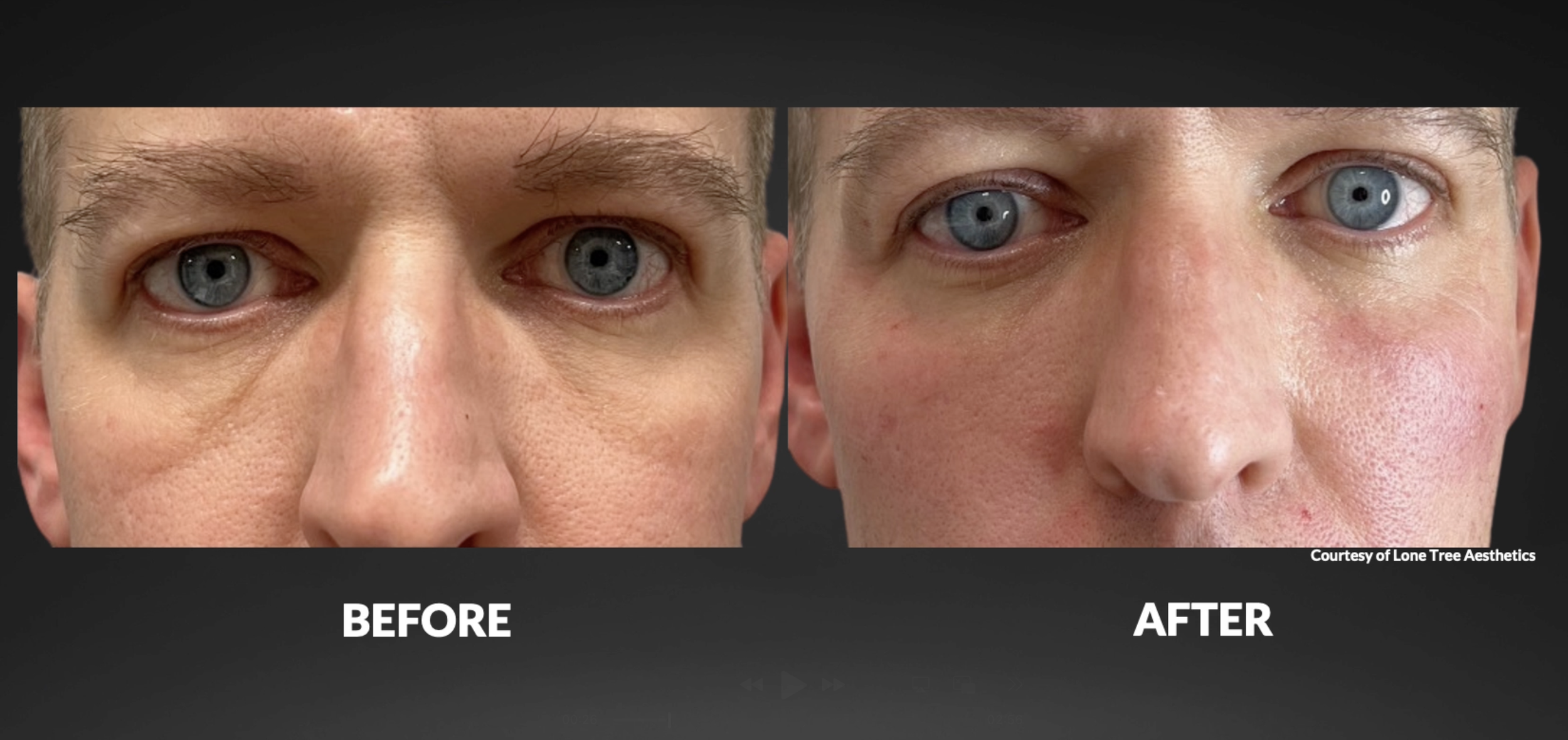 Side-by-side close-up photos of a man's face, showing the area around his eyes before and after a cosmetic treatment. The "before" image shows more wrinkles and sagging skin, while the "after" image shows smoother, tighter skin with fewer wrinkles. Text labels indicate "BEFORE" and "AFTER."