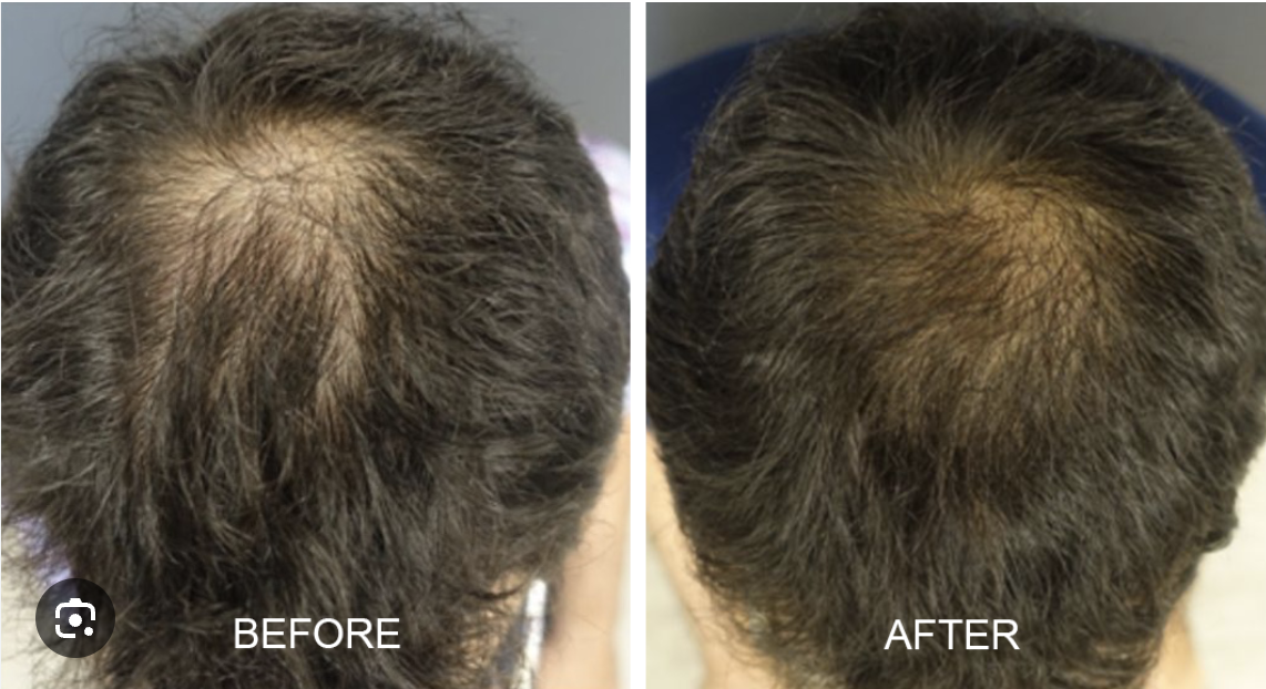 Comparison of a person's scalp showing hair thinning before and after treatment, with the 'before' image demonstrating more hair loss and the 'after' image showing improved hair density.