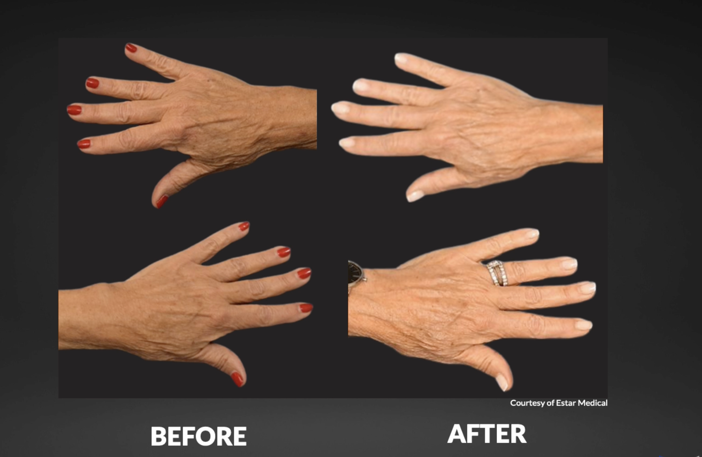Comparison of elderly hands before and after cosmetic treatment, showing improved skin appearance and nail polish, with labels 'BEFORE' and 'AFTER' at the bottom.