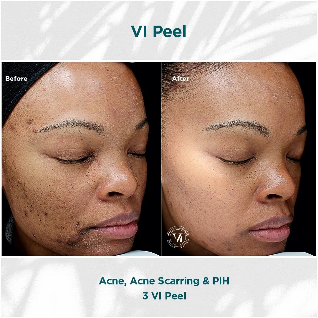 Side-by-side comparison of a woman's face showing improved skin condition after VI Peel treatment, with clearer skin and reduced acne scars in the 'after' image.