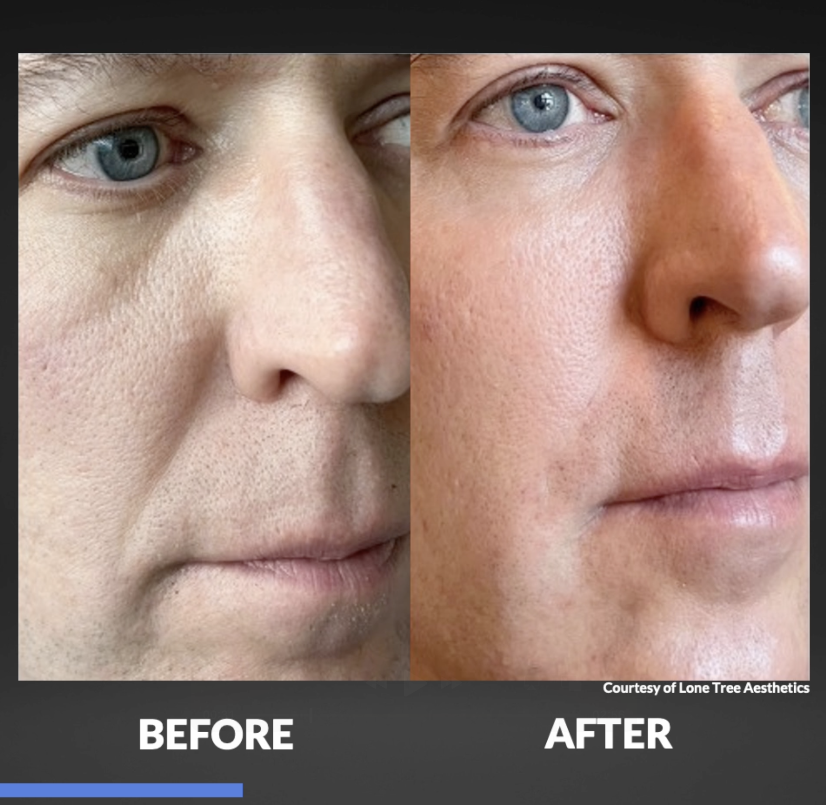Close-up side-by-side comparison of a man's face showing skin improvement, labeled 'Before' and 'After' a skincare treatment, with clear skin and even tone in the 'After' photo.