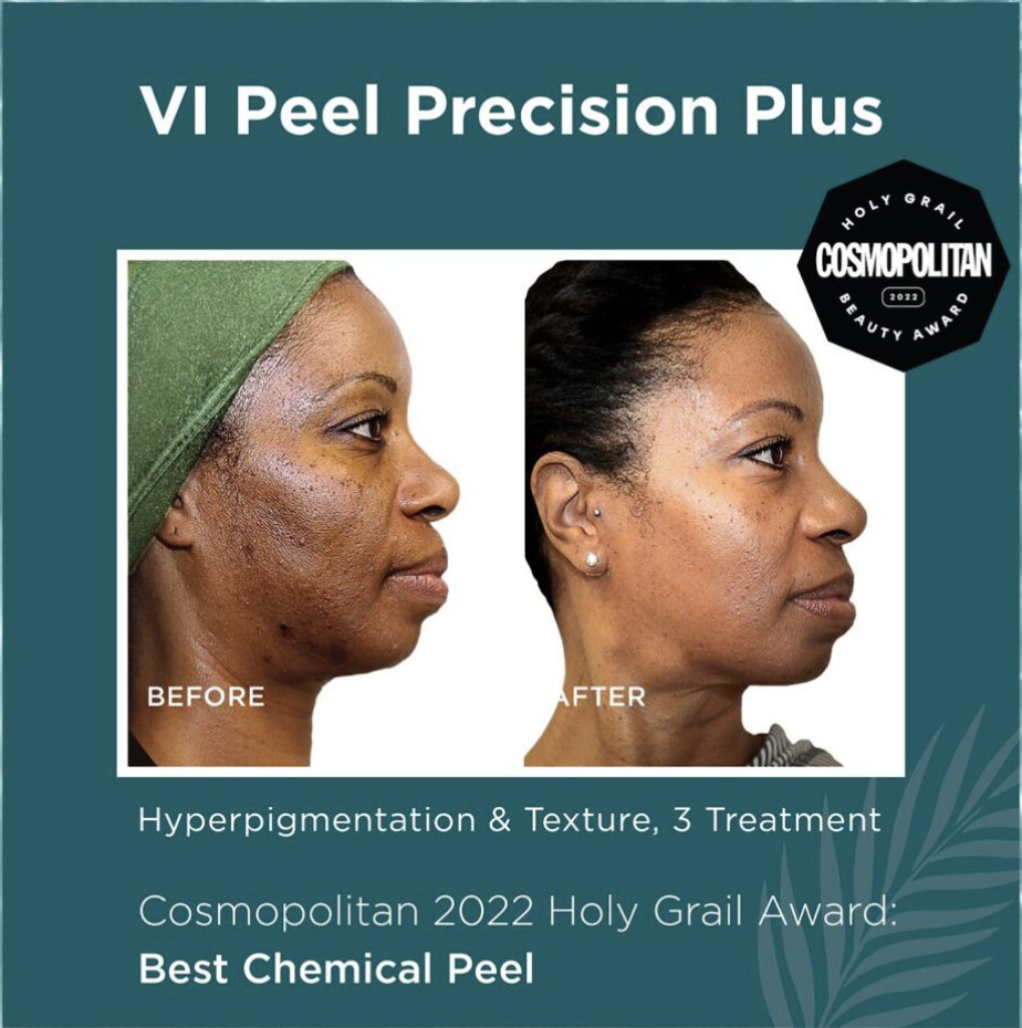 Side-by-side comparison photo of a woman before and after a chemical peel treatment, showing improved skin texture and reduced hyperpigmentation.