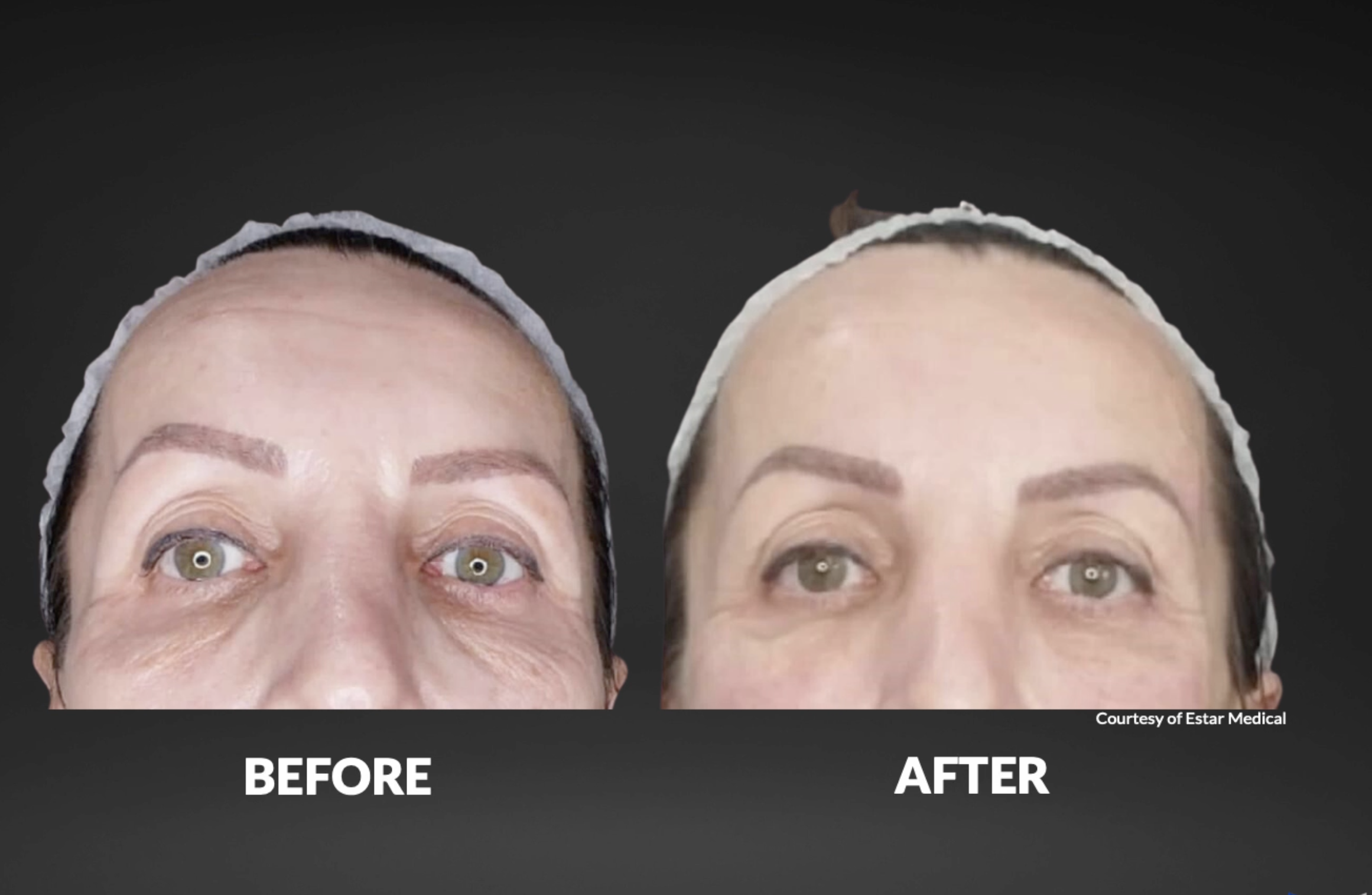 Comparison of a woman's face showing the results of a cosmetic procedure before and after treatment, with the words 'BEFORE' and 'AFTER' beneath each image.