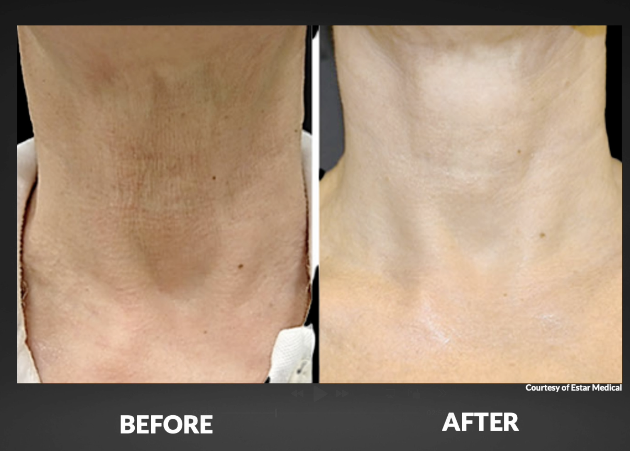Side-by-side comparison of a person's neck and upper chest area, showing skin before and after a treatment. The 'before' image shows uneven, darker skin tone with visible imperfections, while the 'after' image shows smoother, lighter, and more even skin.