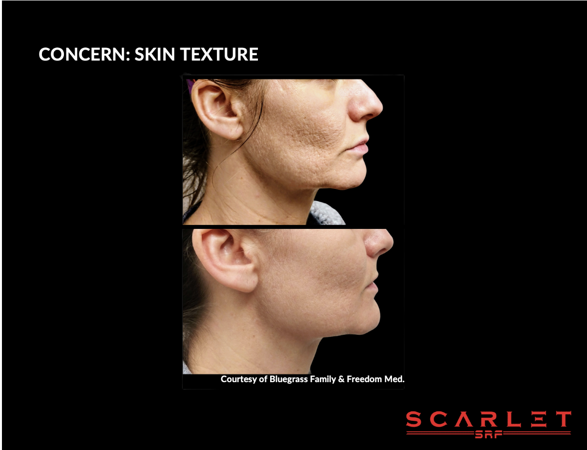 Comparison of skin texture before and after skin treatment, showing reduced wrinkles and smoother skin on the lower image.