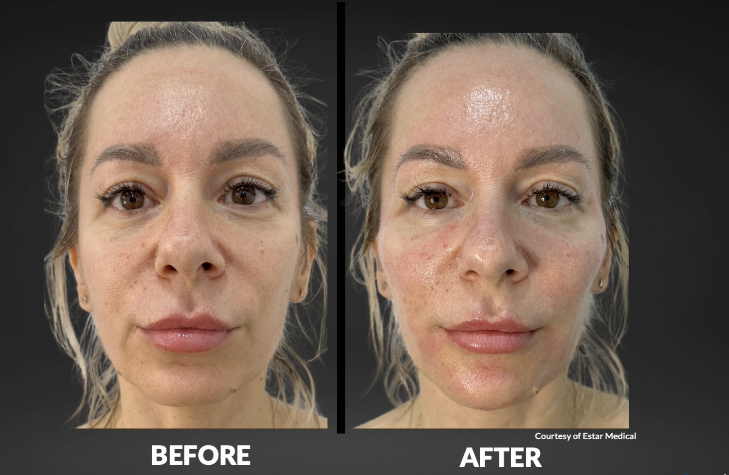 Side-by-side comparison of a woman's face before and after a skincare treatment, with visible improvements in skin texture and reduced redness.