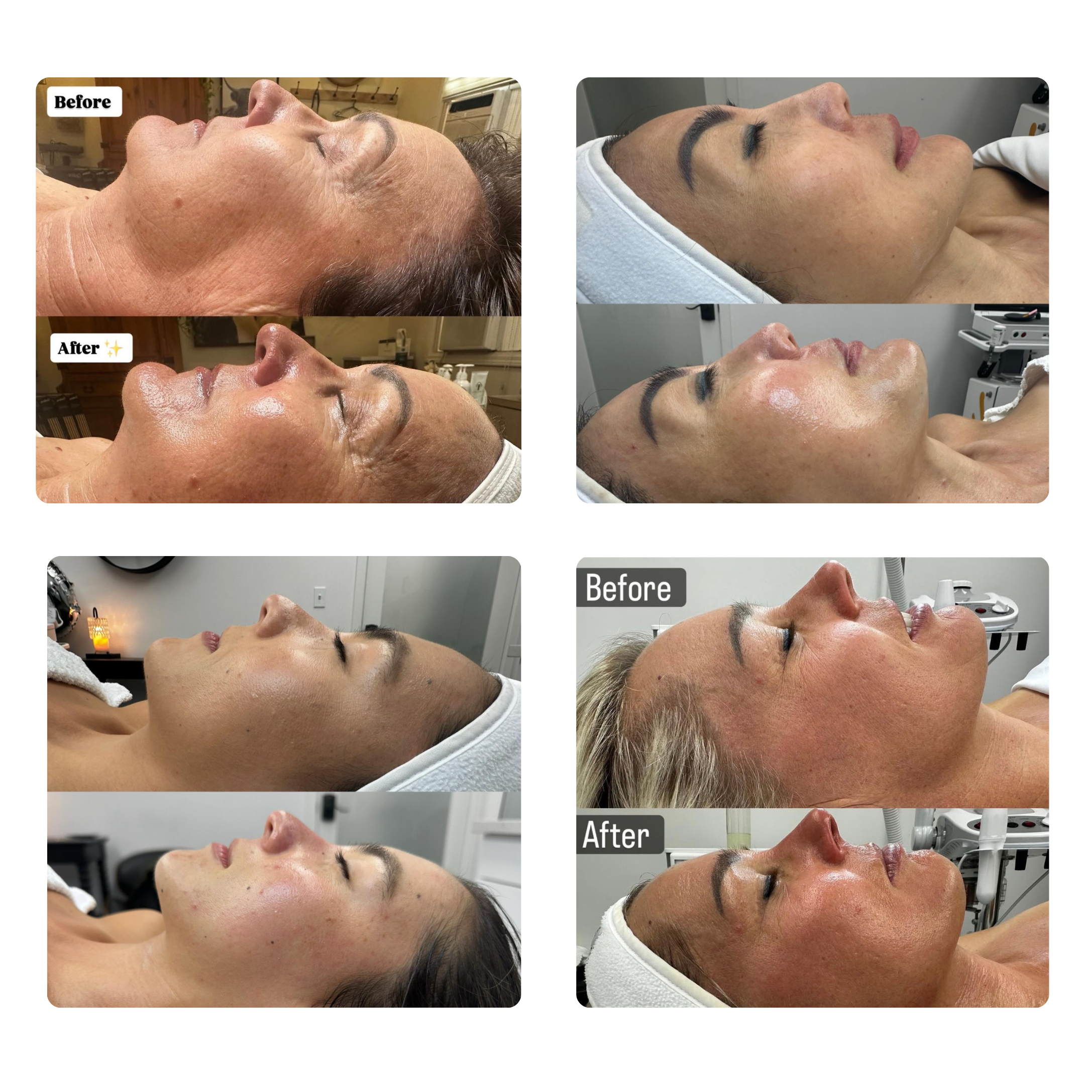 A collage of before and after photos of clients who received aesthetic and facial treatments from Kanoe