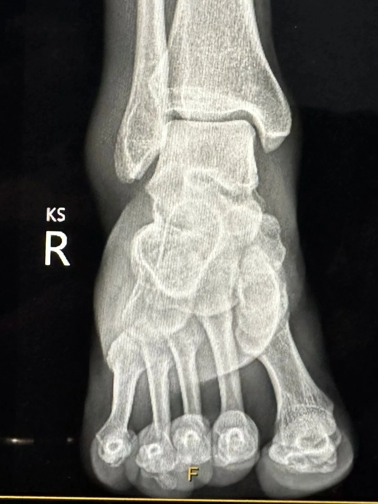 How Do You Get Back to Running After Rolling Your Ankle?