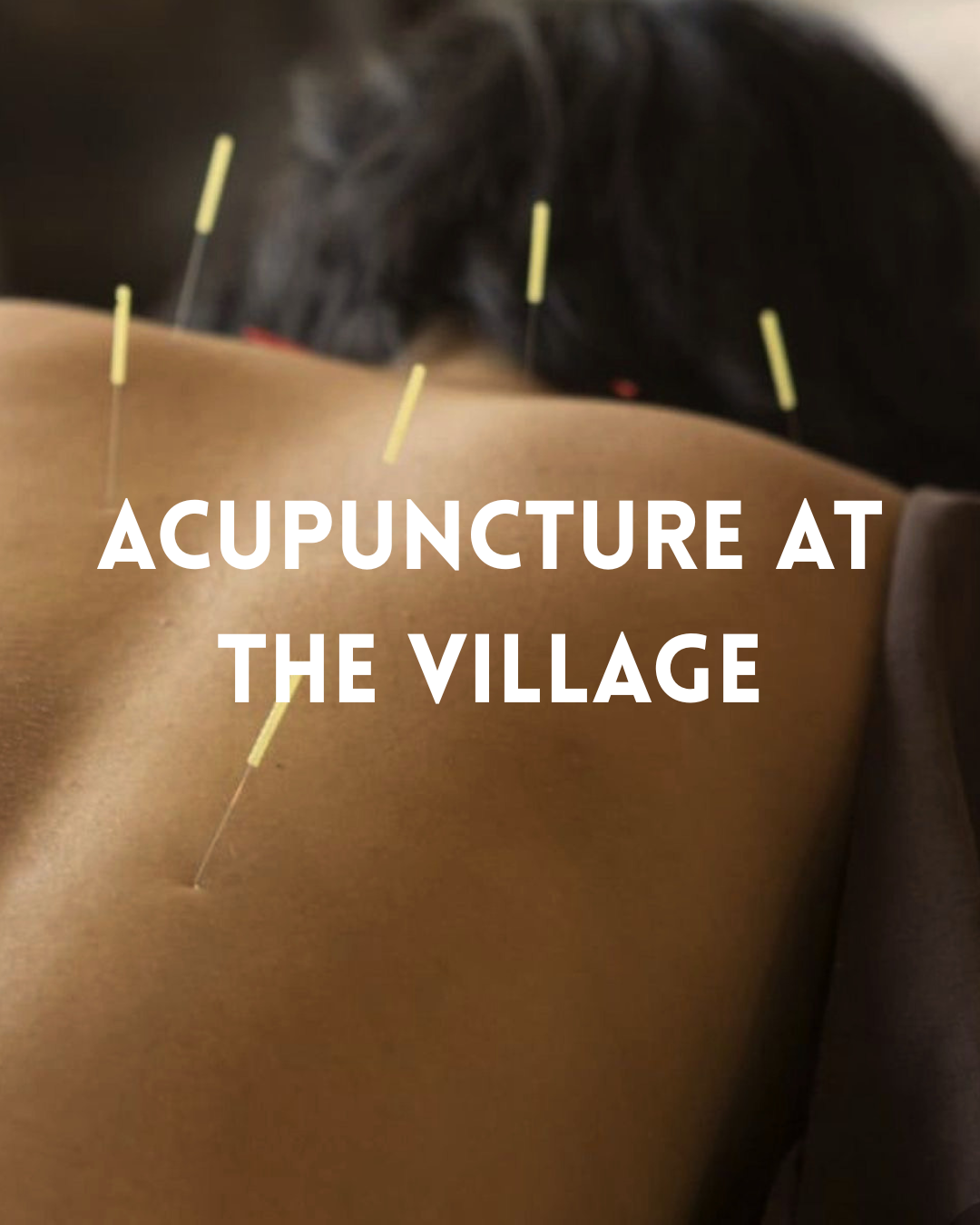 Acupuncture