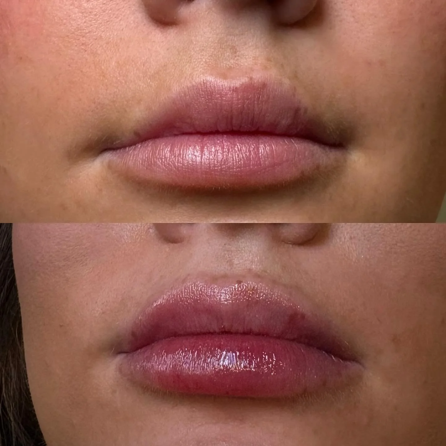 Before |  After
Dissolving with lip enhancement 

This was a true trust the process journey but check out those end results! 😍
Over a few sessions we worked towards dissolving old and migrated product, followed by strategic enhancing &amp; shaping f