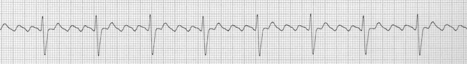 atrial flutter ecg
