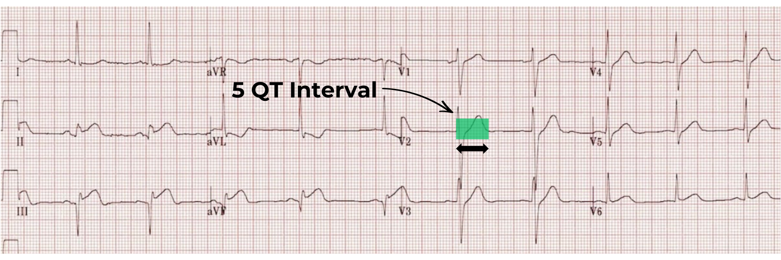 12 lead ECG