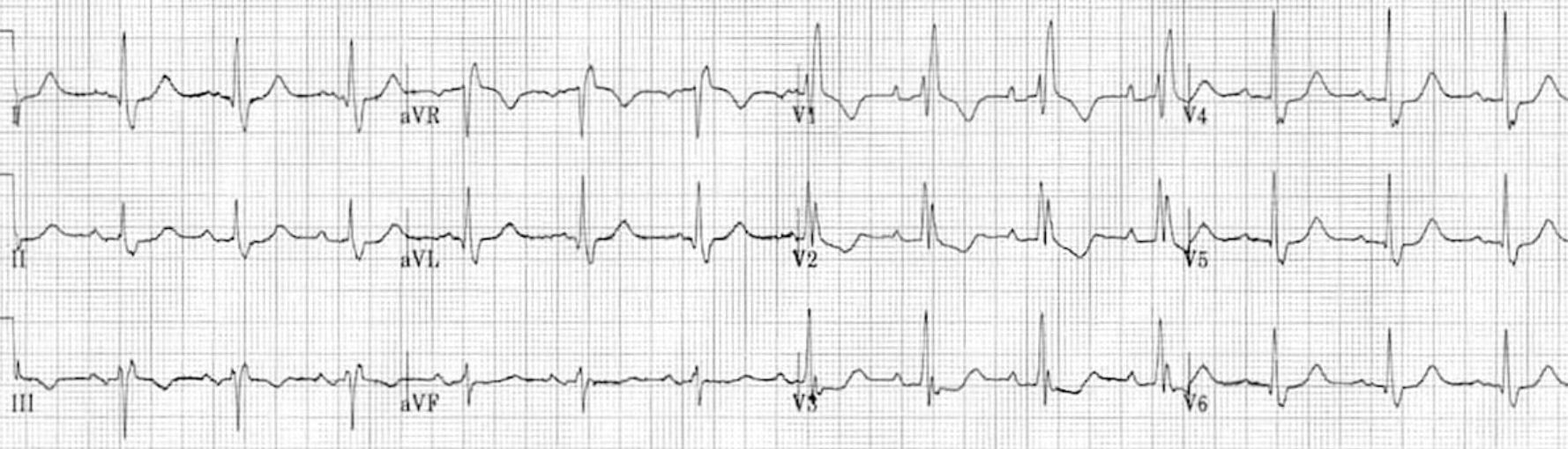 right bundle branch block ecg