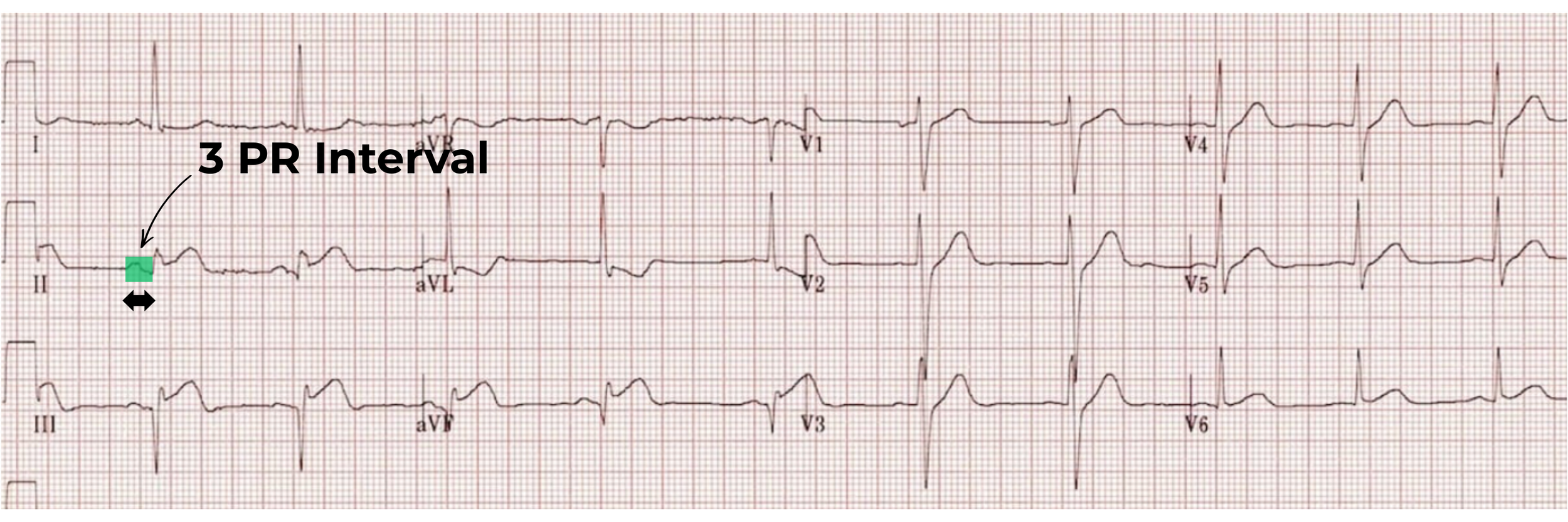 12 lead ECG