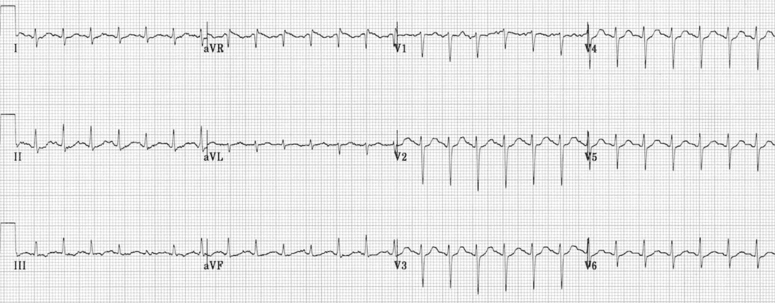 Sinus Tachycardia ECG
