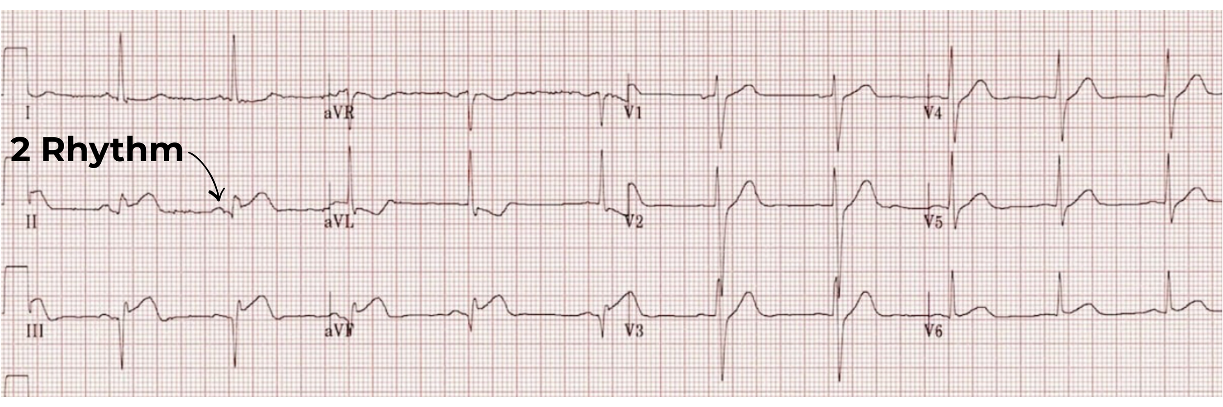 12 lead ECG
