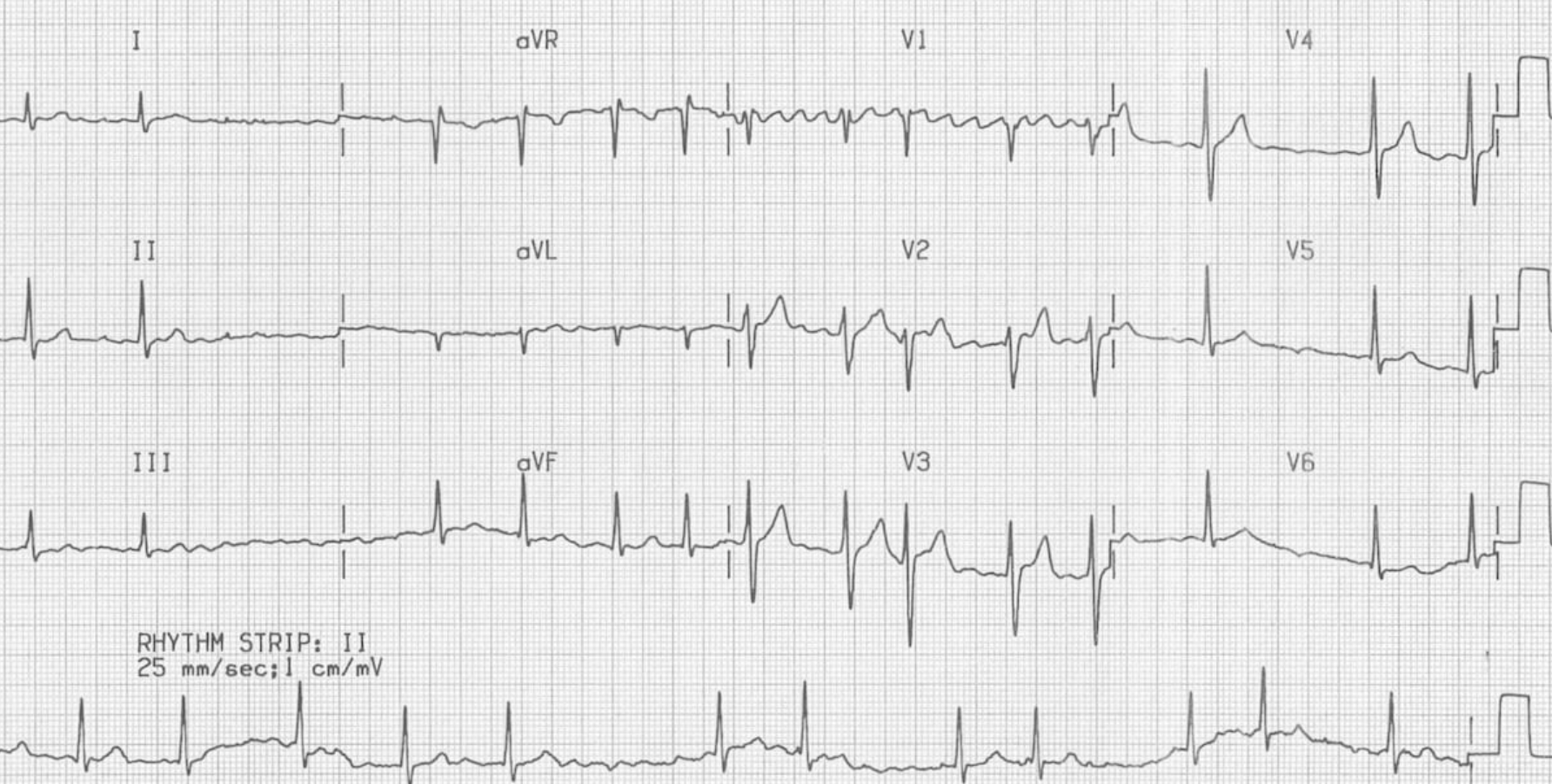 atrial fibrillation ecg