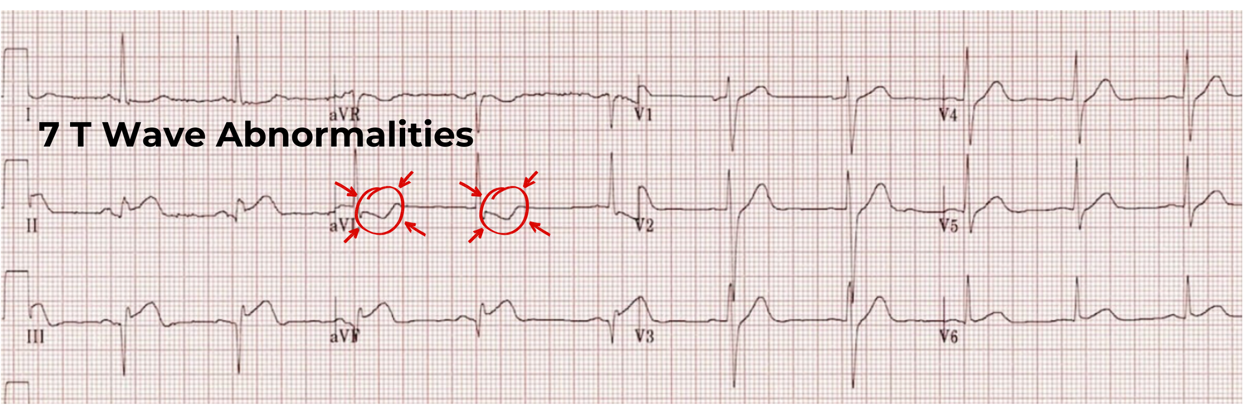 12 lead ECG
