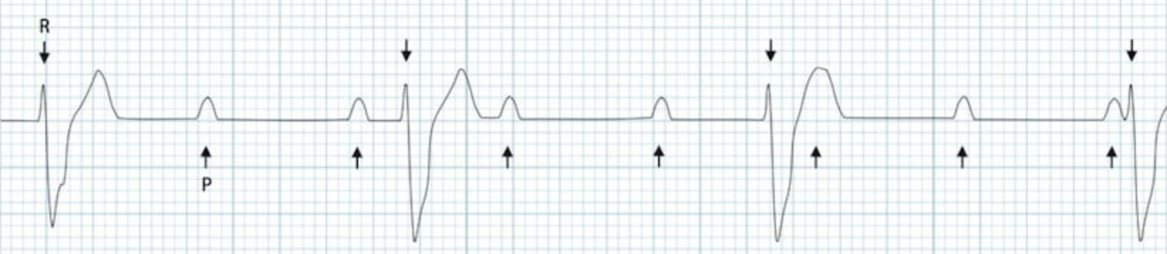 third degree block ecg