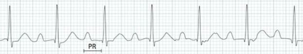 first degree av block ecg