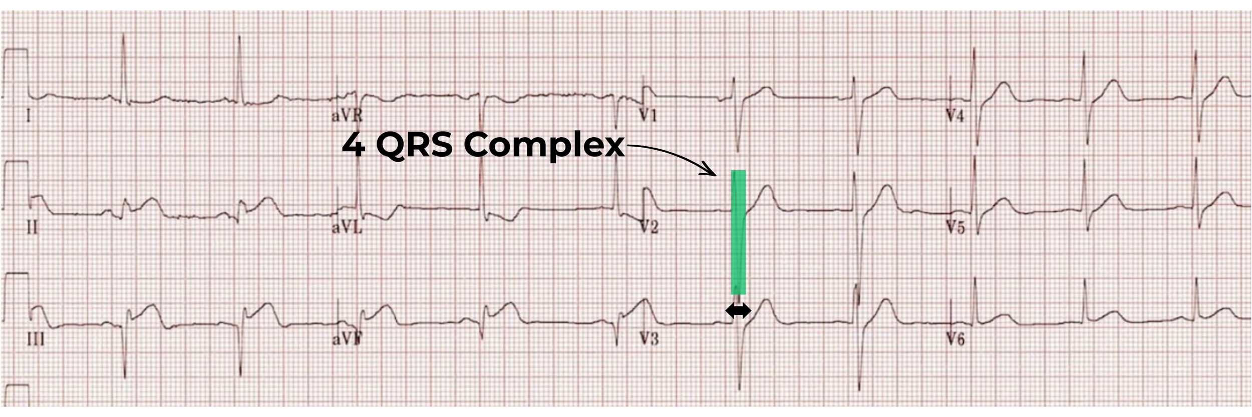12 lead ECG
