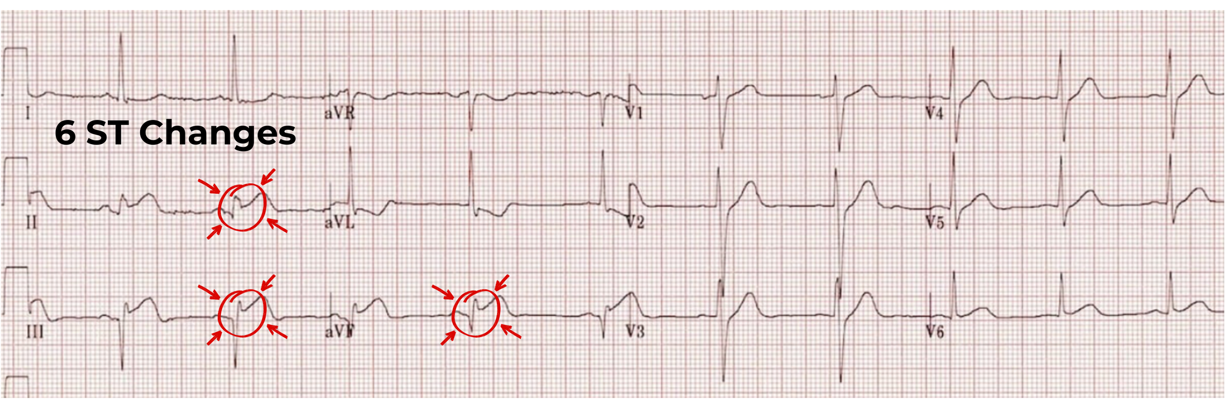 12 lead ECG