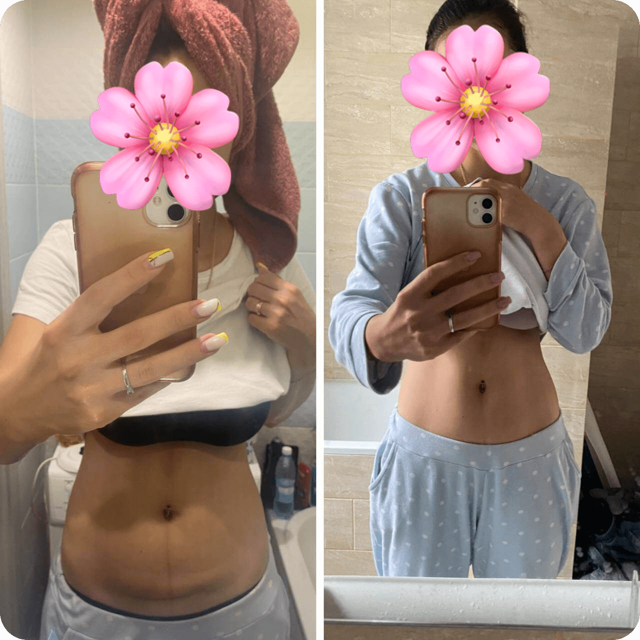 A side-by-side comparison photo of a person's torso, showing a before and after transformation. On the left, the person is wearing a towel on their head, a white shirt lifted to reveal the stomach, and light-colored bottoms. On the right, the individual is in pajamas with a polka dot pattern, again lifting the shirt to show a toned abdomen. The person’s face is obscured by a flower sticker in both images.