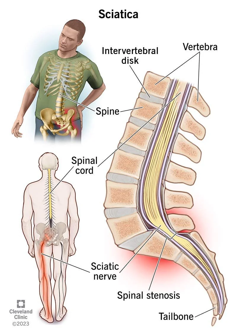 Image showing causes of sciatica, showing the spinal cord and how the sciatic nerve is squeezed by vertebrae