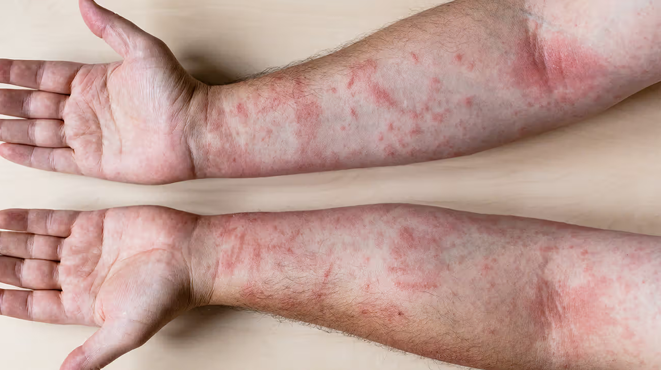 Contact Dermatitis