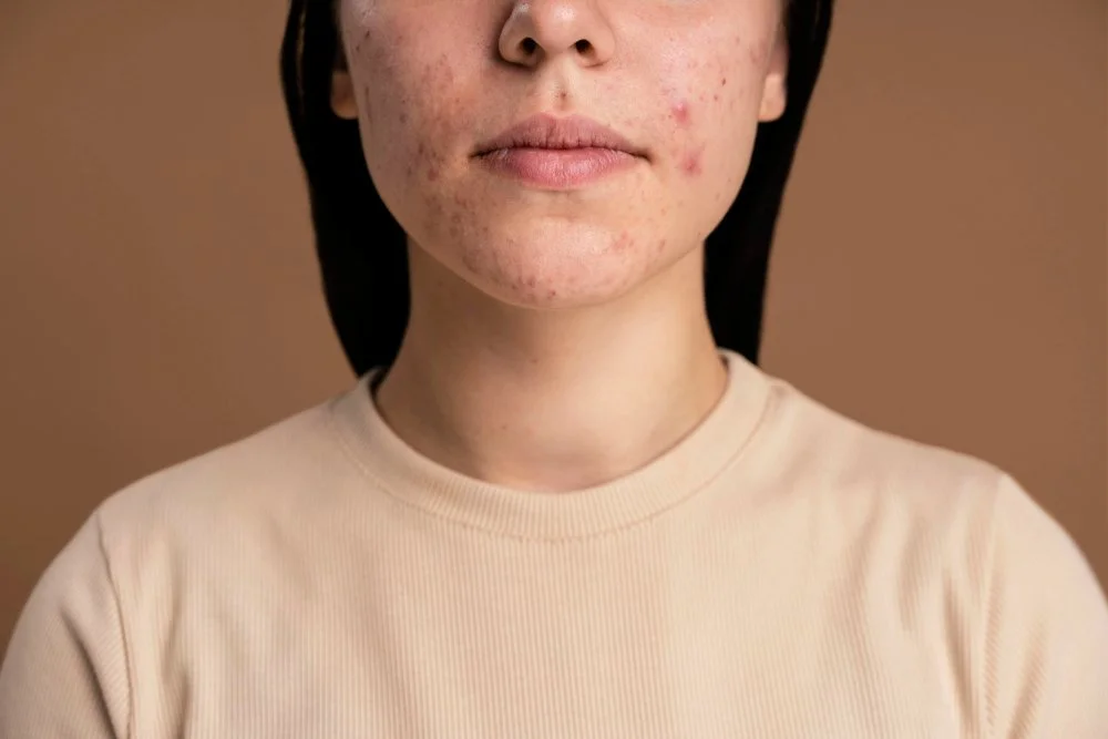 Acne (Taghiyawat)
