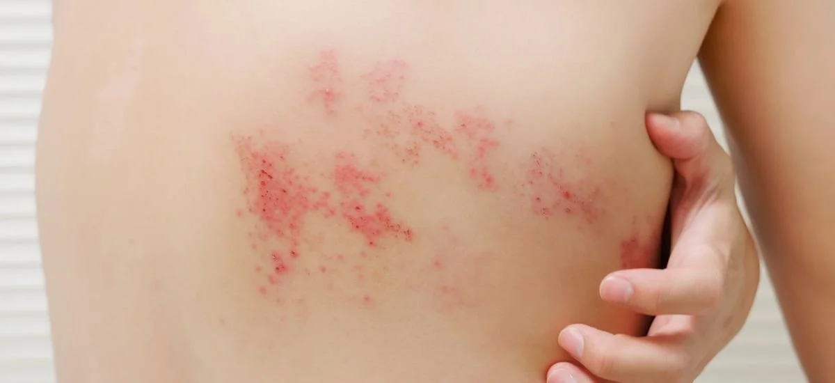 Shingles (Herpes Zoster)