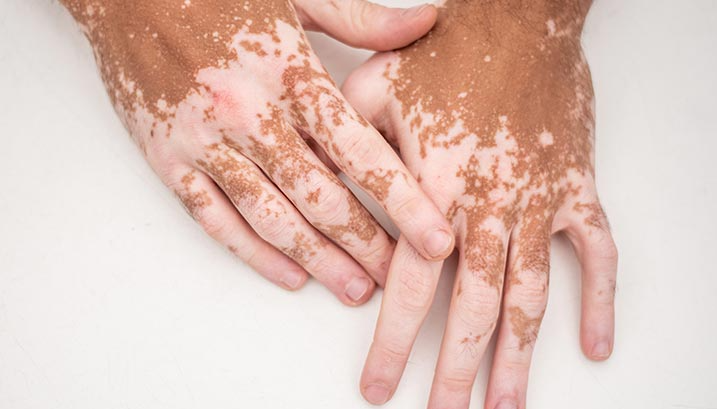 vitiligo