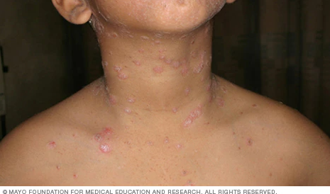 Psoriasis