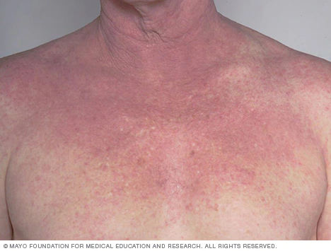 Eczema (Atopic Dermatitis)