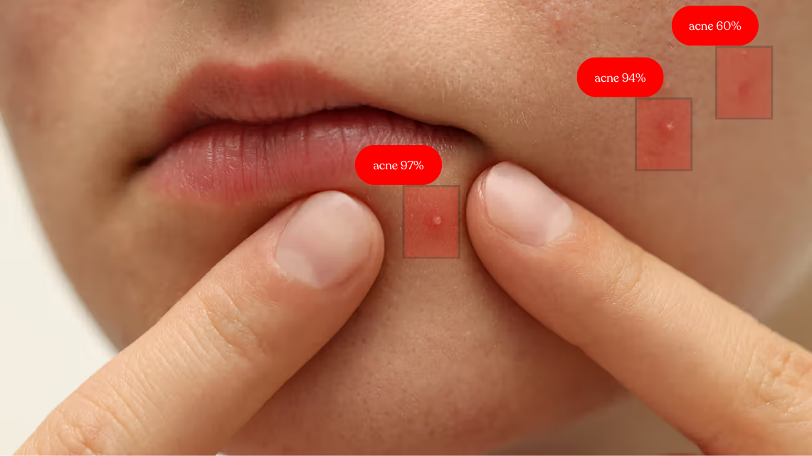 Acne_2.png
