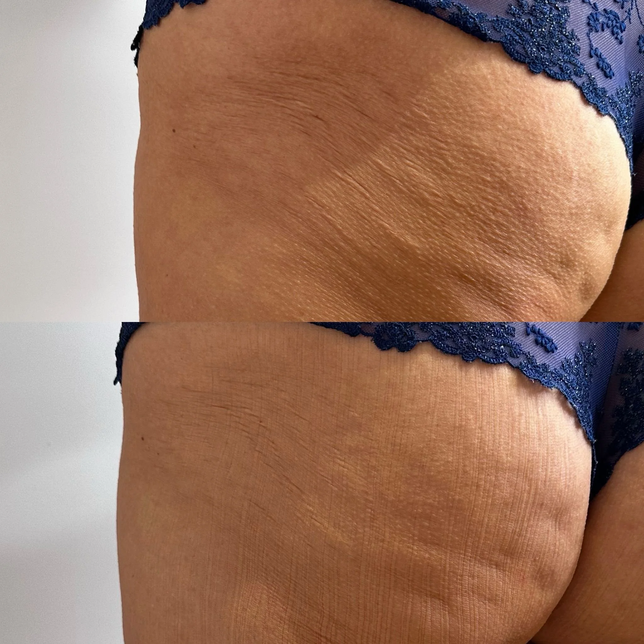 Close-up of the skin on a person's thigh, showing the texture and appearance of the skin.