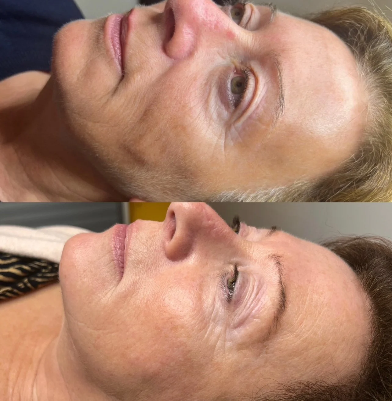 Comparison of a woman's face before and after a cosmetic treatment, showing improvements in skin texture and appearance.