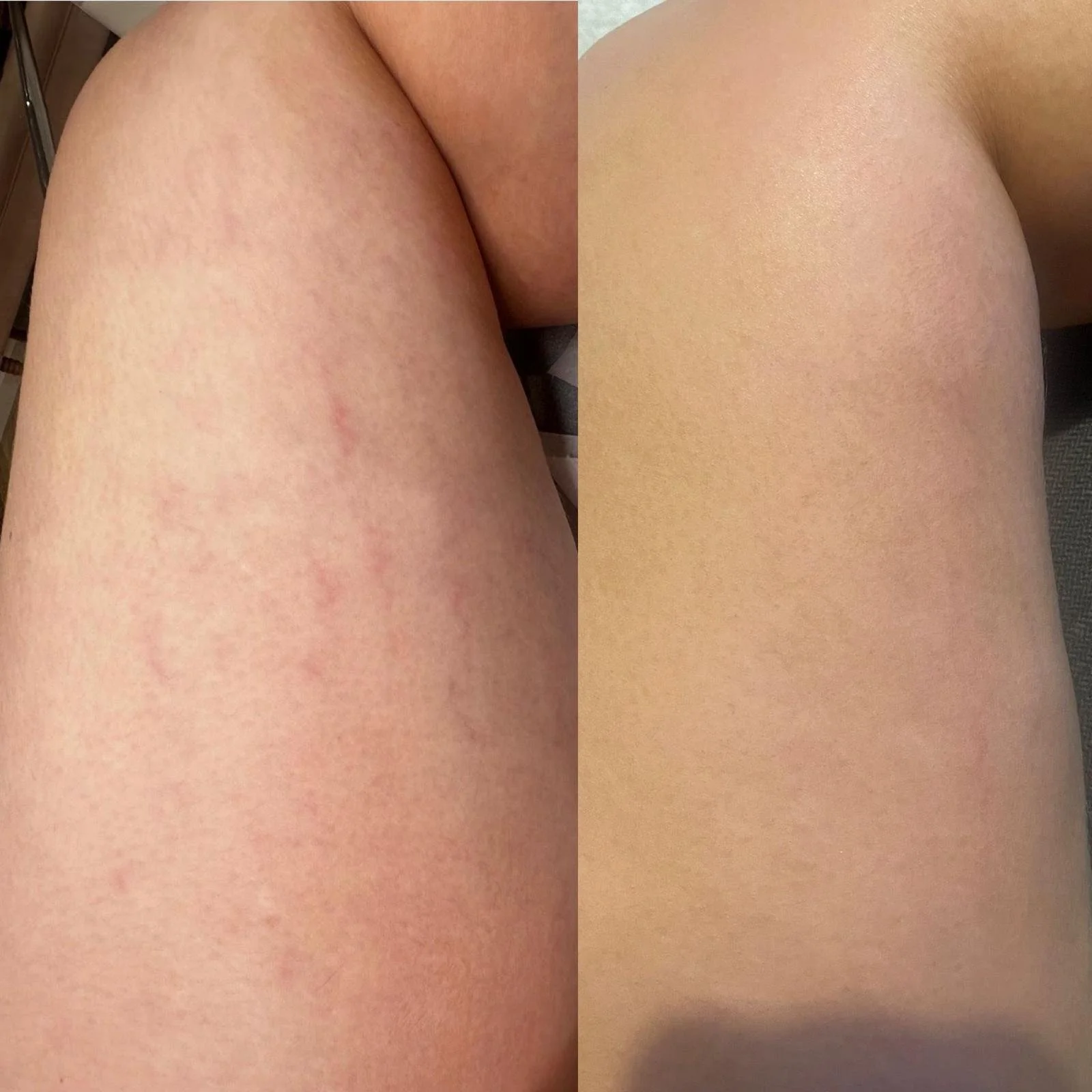 Close-up of a person's thigh showing the before and after of skin treatment, with redness and smooth skin respectively.