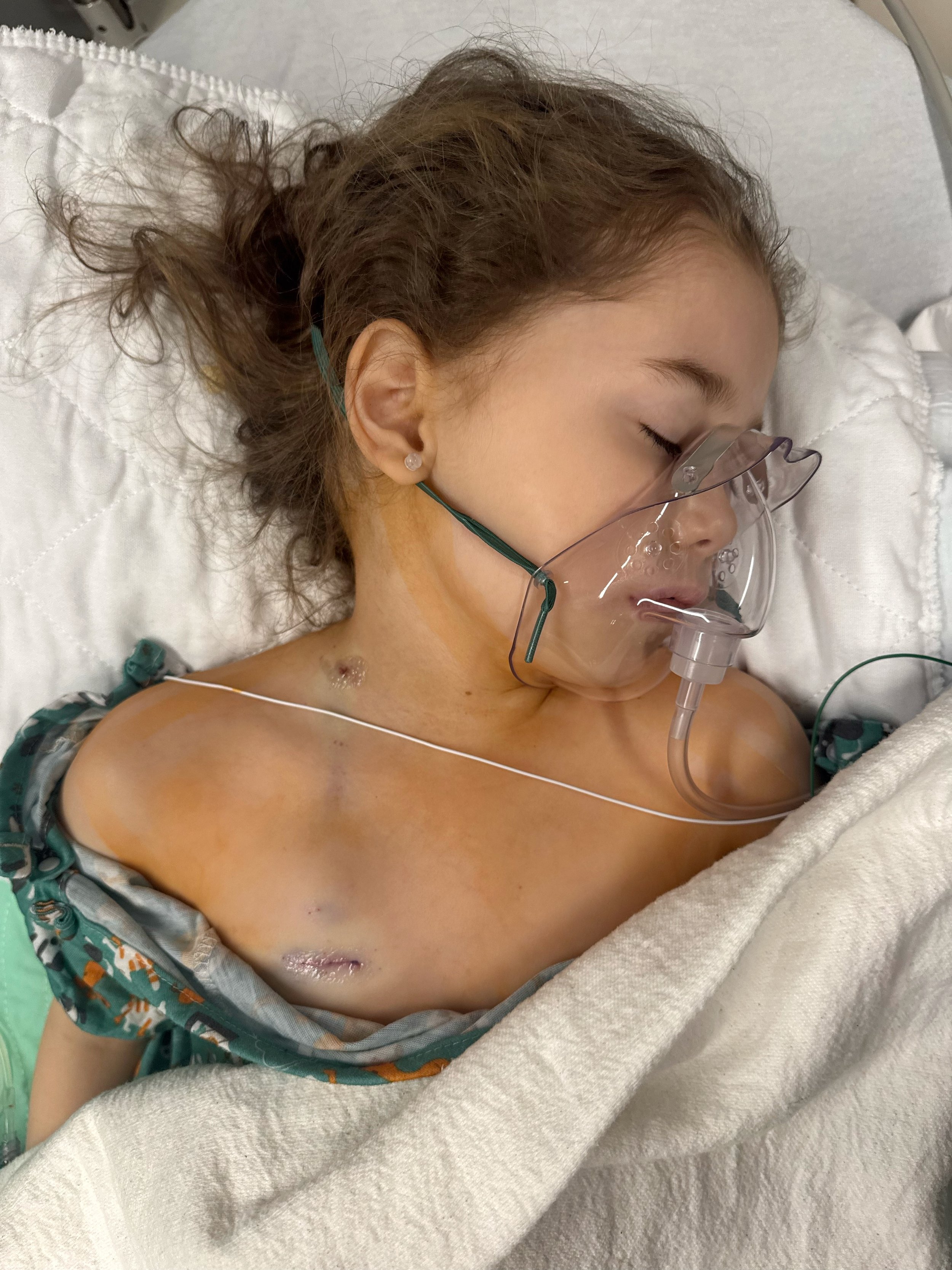 Side effects &amp; Port-a-Cath