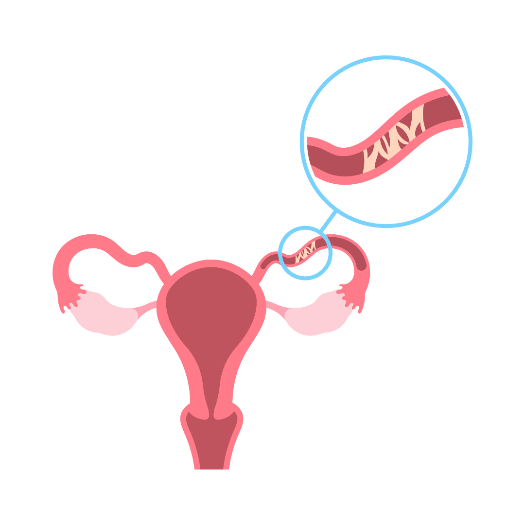Endometriosis Patient Resources & Support Guide | Endo Excision for All ...