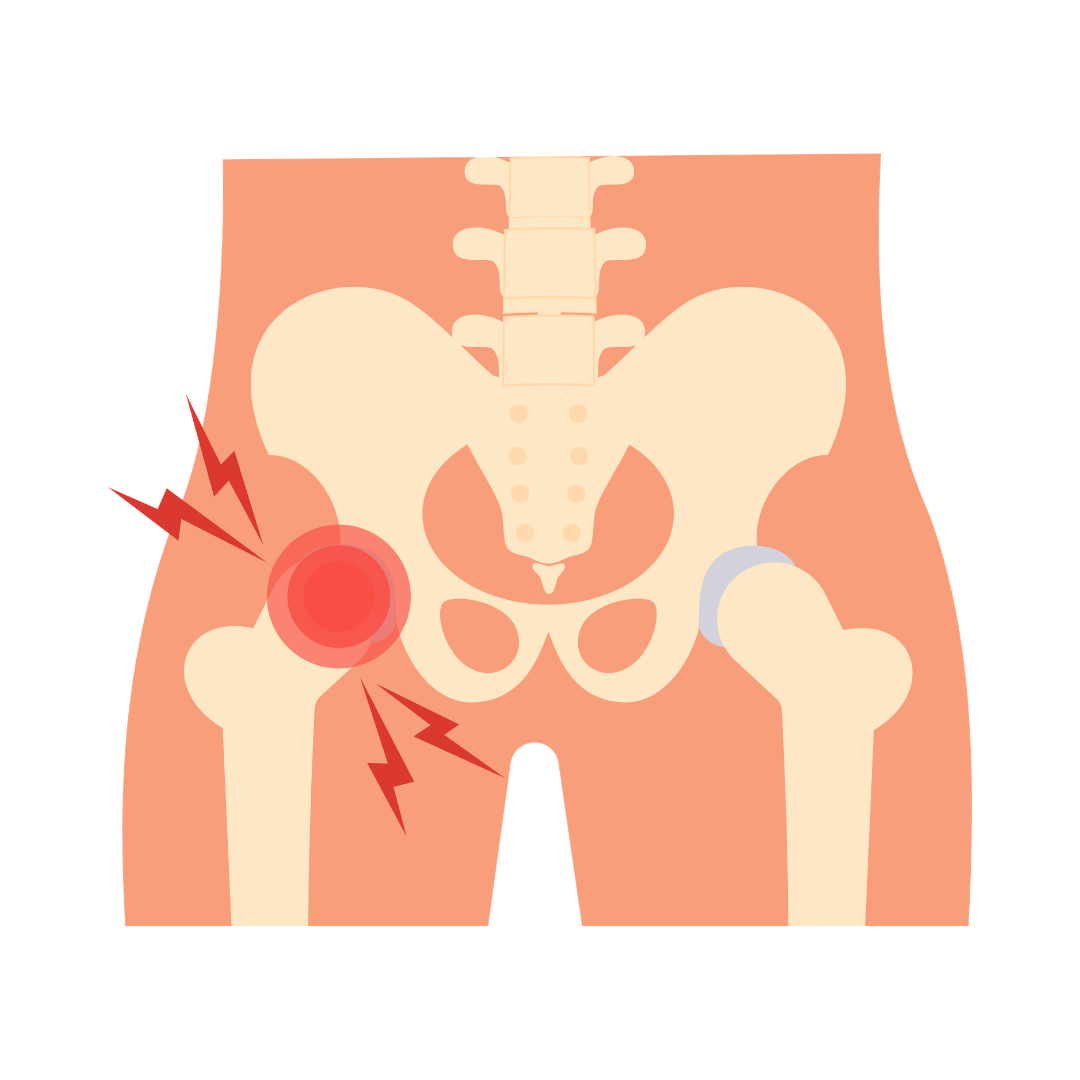 Pelvic Congestion Syndrome (PCS): A Hidden Cause of Chronic Pelvic Pain