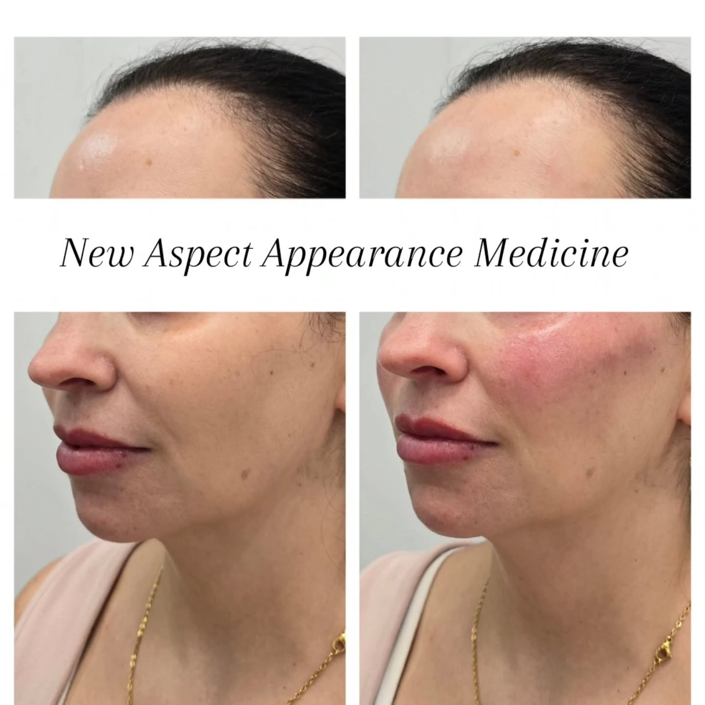 This absolute stunner maintains her beautiful youthful appearance by having regular maintenance treatments with me. If I told you her age, you wouldn't believe me! 😱

Here, I did a wee antiwrinkle and cheek filler refresh. I'm living for those sculp