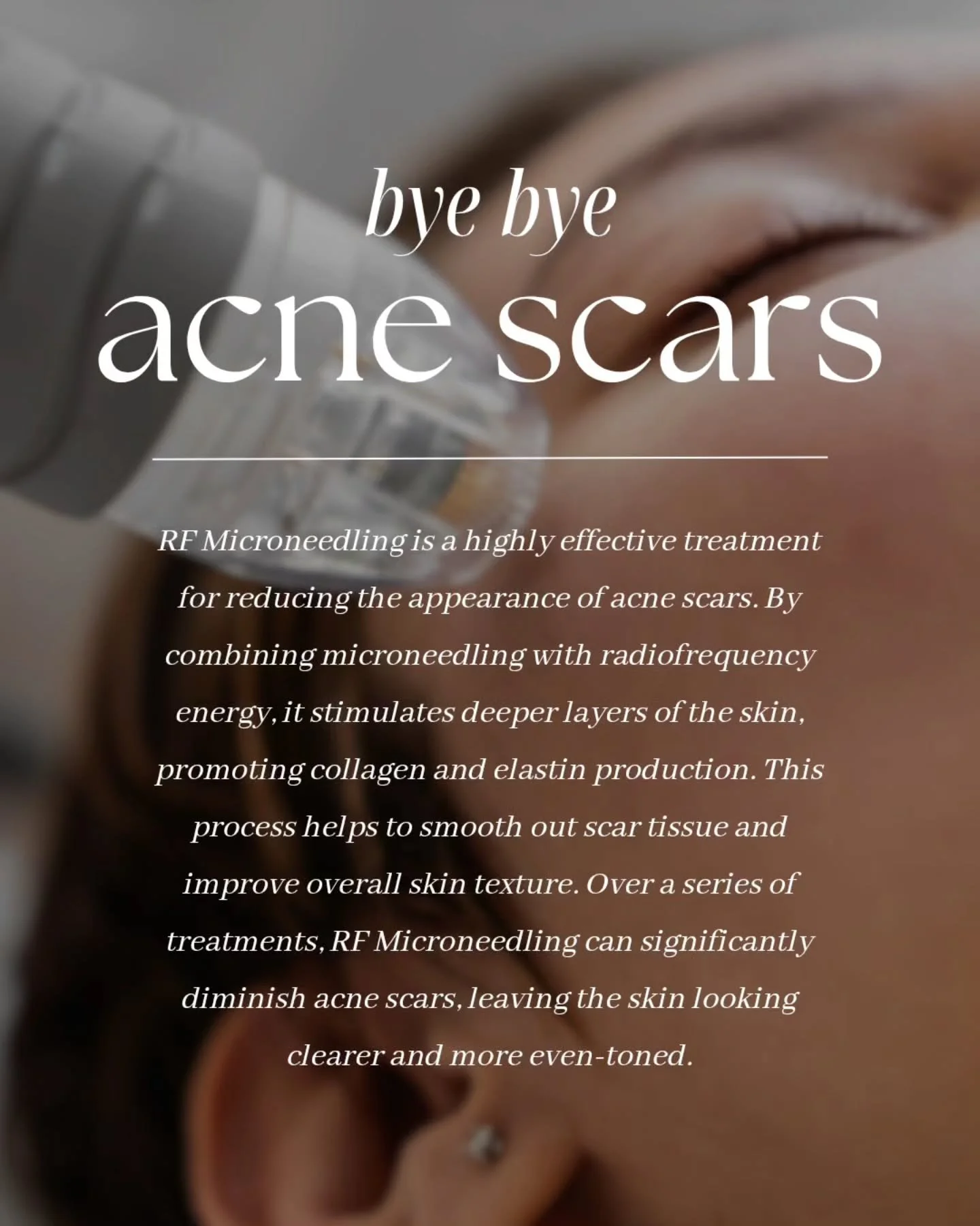 Microneedling &amp; Acne Scarring: Everything You Need to Know 

Acne scars are more than skin deep. They form when inflammation from acne damages collagen and elastin in the healing process, leaving behind indented or uneven areas. Unlike pigmentati