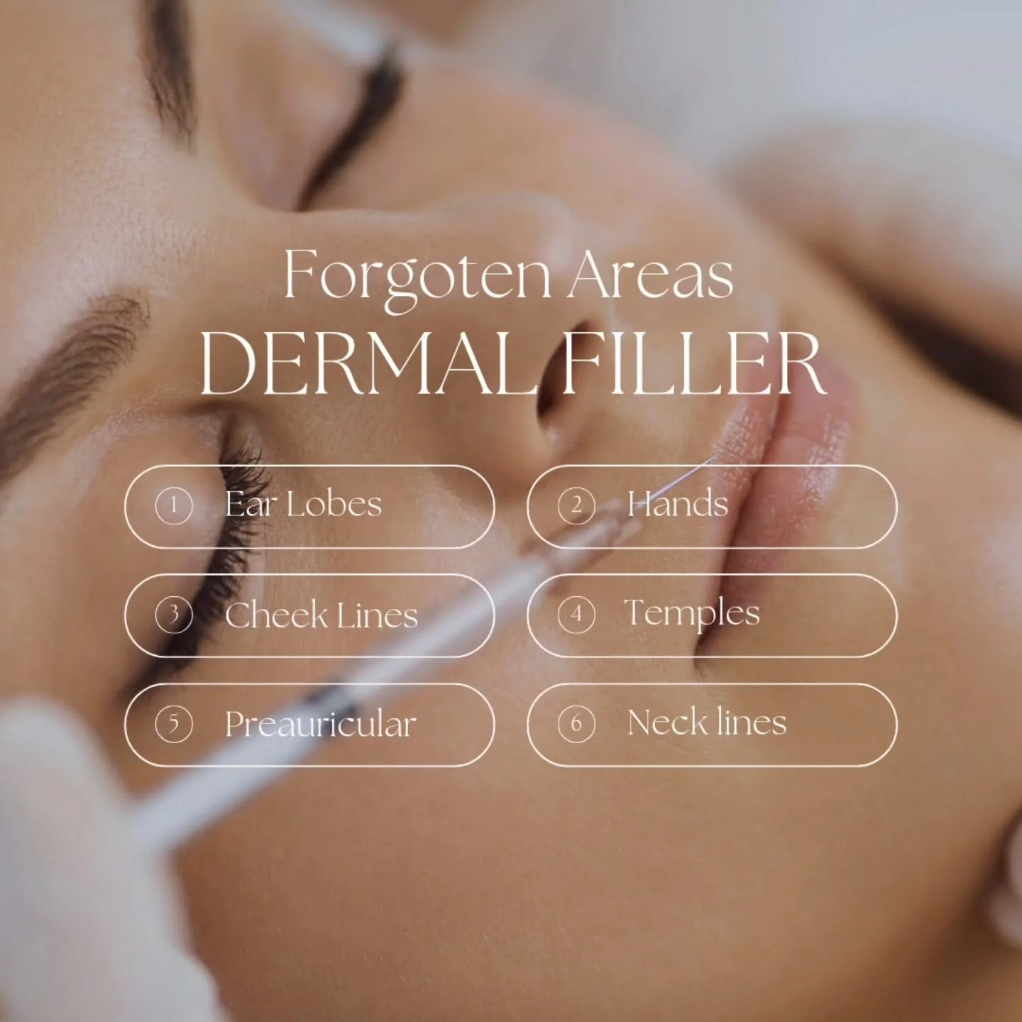 💉 Often Forgotten Filler Areas 💉

Most people think of filler for lips or cheeks, but there are many other areas where subtle volume loss shows first &mdash; and treating them can create a refreshed, balanced look without obvious changes.

👂 Ear l