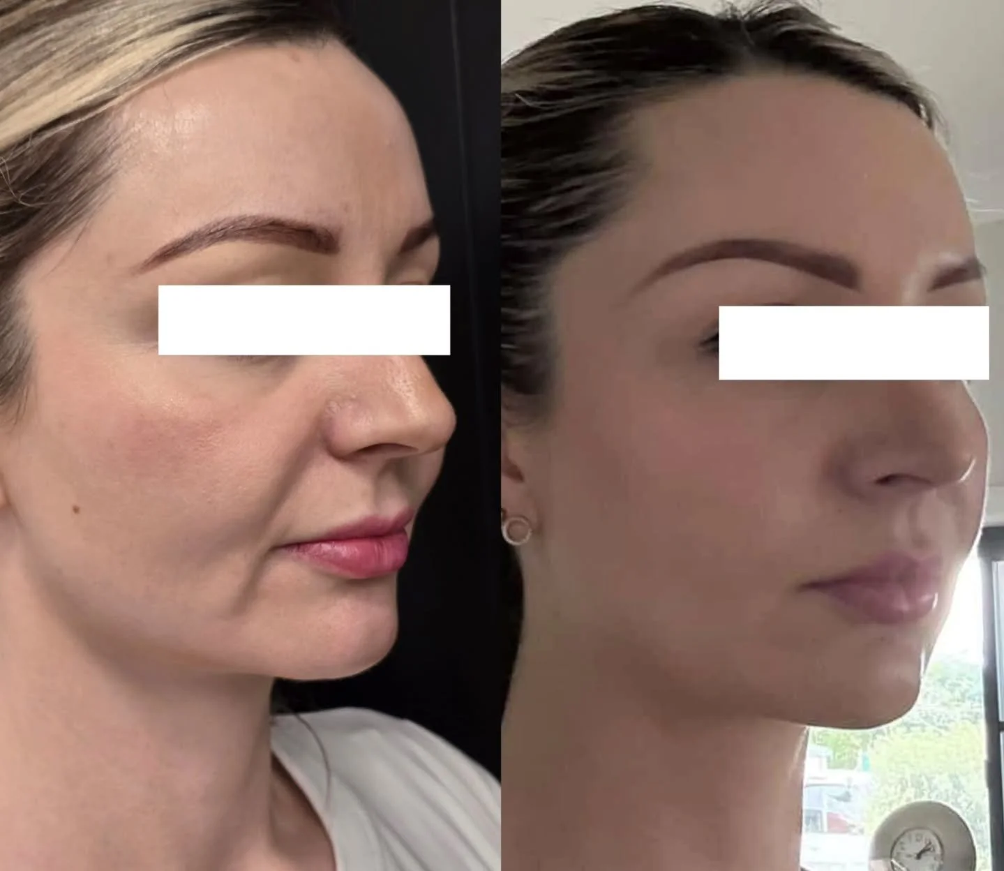 This absolute stunner came to see me a few weeks ago concerned with a couple of areas in particular.  Over a couple of sessions we have some refining and I think she looks incredible. 

Here I have treated her with a combination of filler and botulin