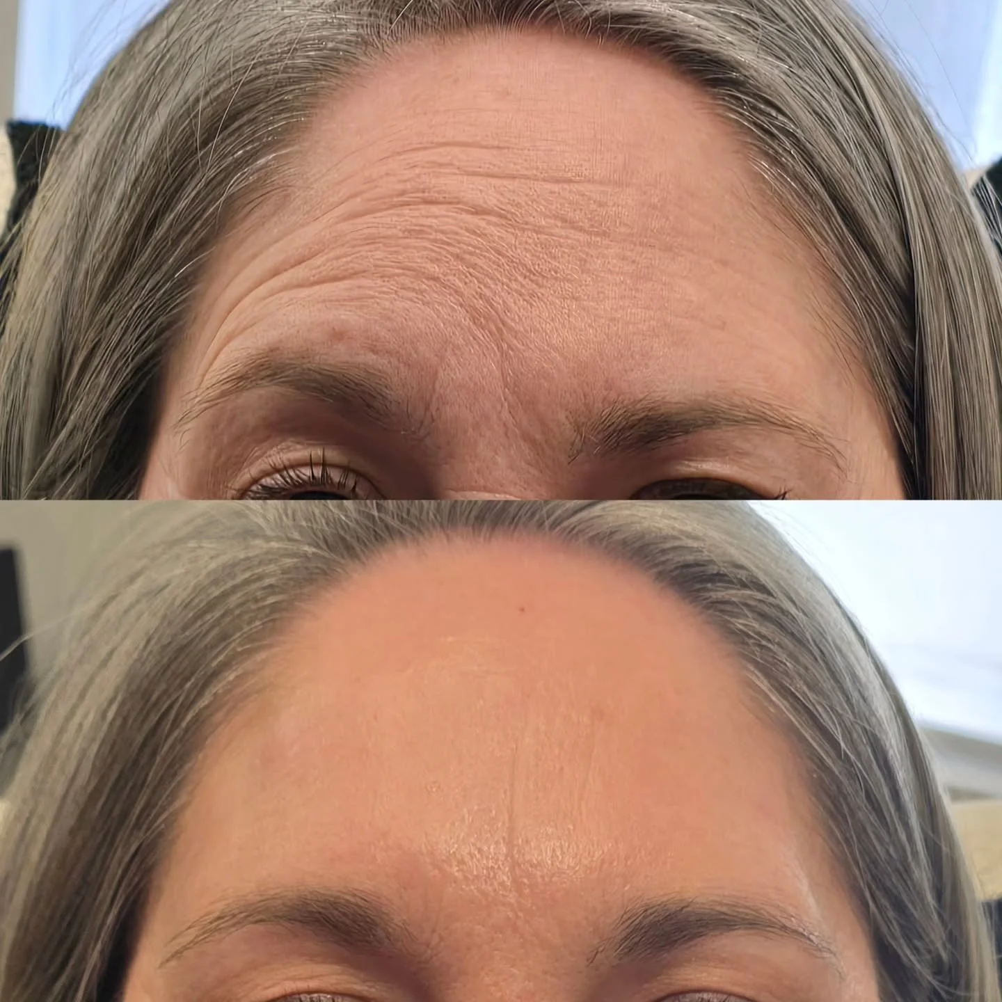 ✨️Forehead Tox &amp; Facial Symmetry ✨

When we think of anti-wrinkle, we often focus on softening lines &mdash; but one of its most underrated benefits is creating balance and symmetry
 across the face.

🧠 The forehead muscles don&rsquo;t always wo