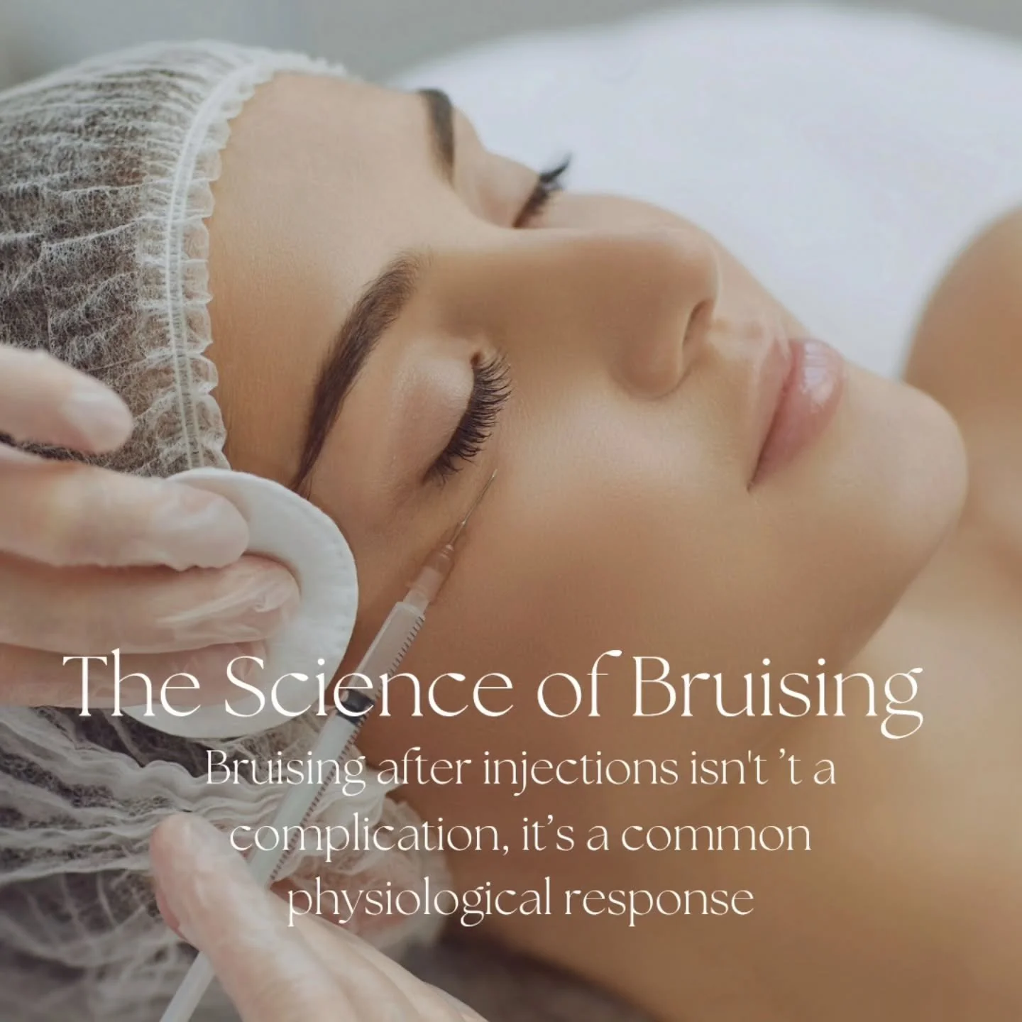 The Science of Bruising: What Really Happens Under the Skin

Bruising after injections isn&rsquo;t a complication, it&rsquo;s a common physiological response. When tiny blood vessels, called capillaries, rupture during treatment, blood leaks into the
