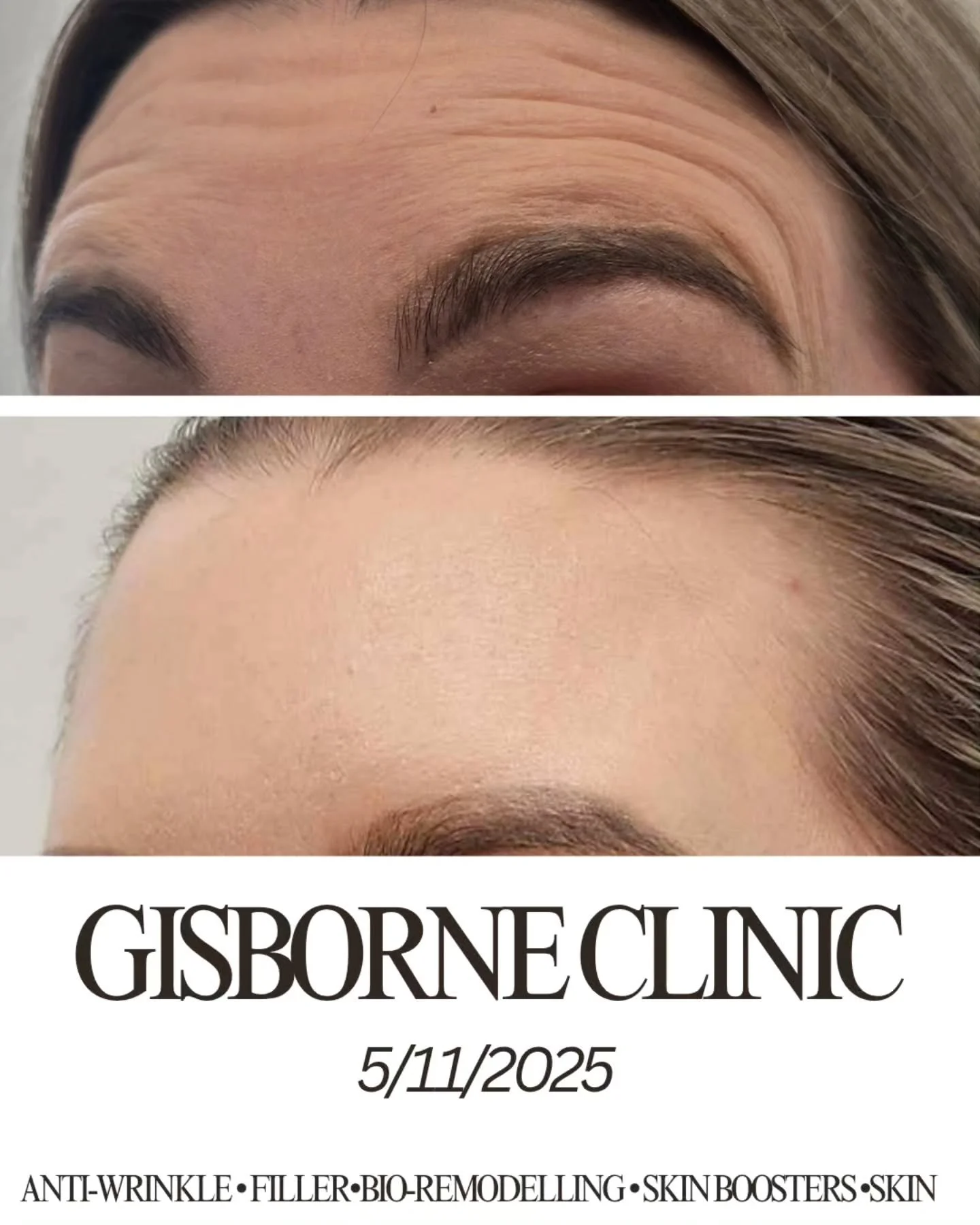 ✨️Gisborne Clinic ✨

Whether you&rsquo;re looking for subtle enhancements, refreshed skin, or support with treatment planning 

 Offering:
&bull; Anti-wrinkle
&bull; Dermal filler
&bull; Skin boosters 
&bull; Biostimulators 

📍 Location: 155 Gladsto
