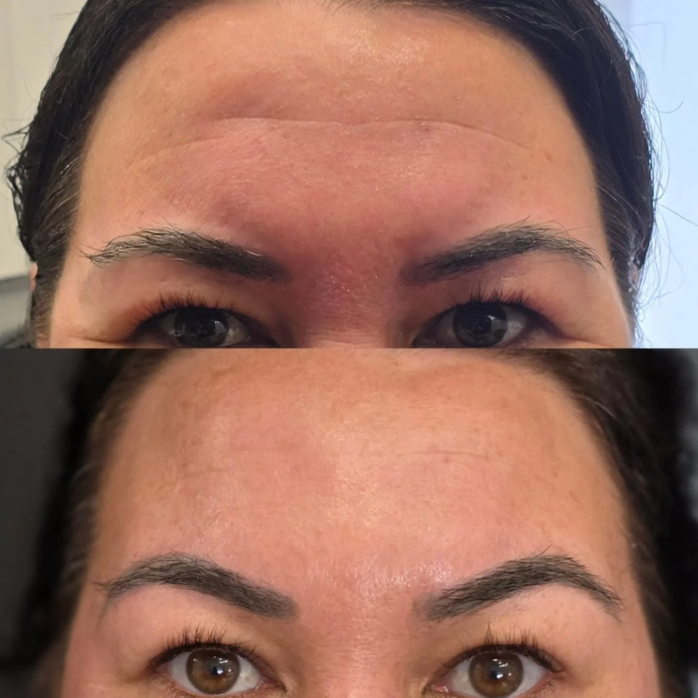 Some people naturally have very active glabellar (frown) muscles. As you can see here, my beautiful client's muscles are very strong, and you can see the outline even at rest. When contraction of the muscle occurs, the muscle bulk is even more emphas