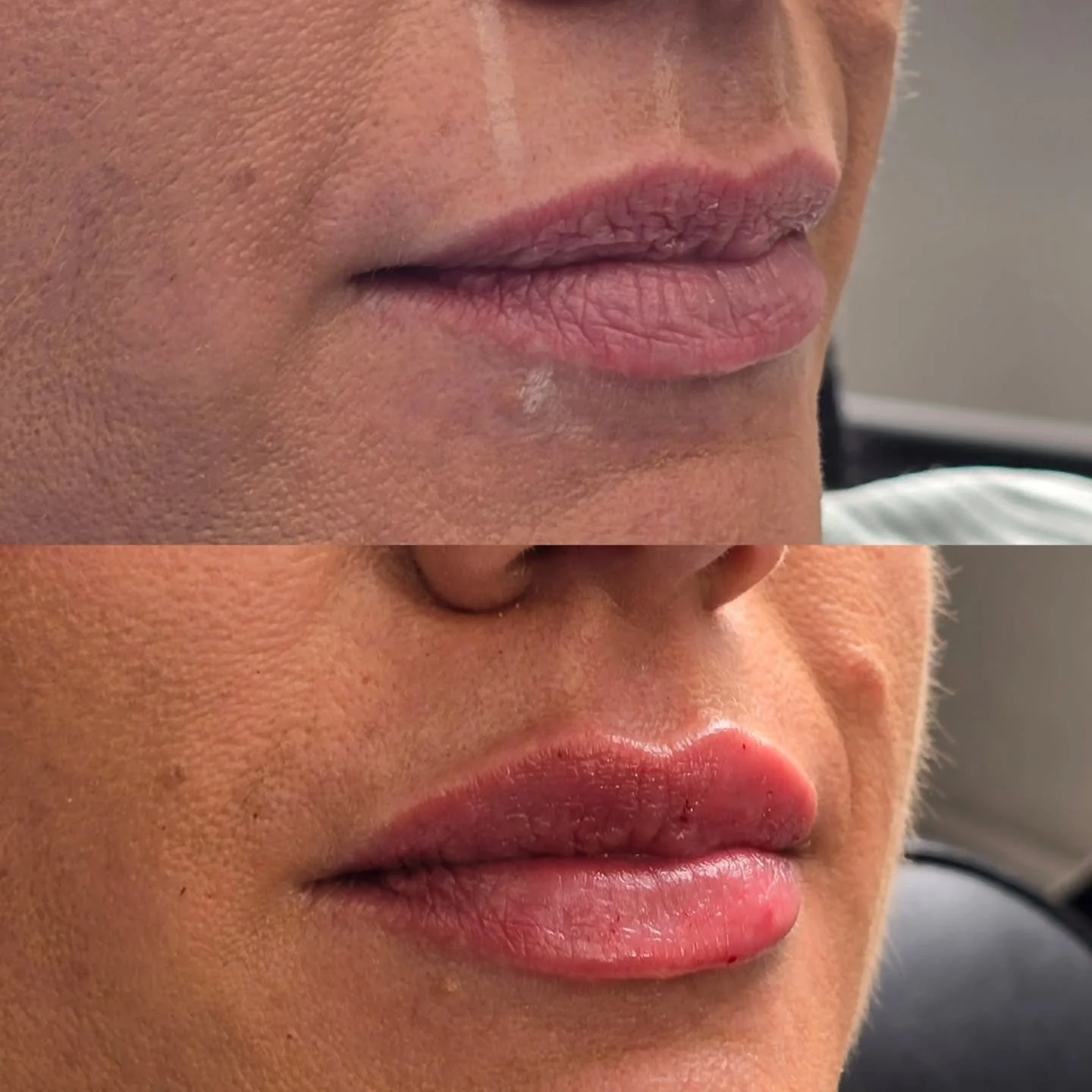 I'm so excited to share these beaaaauuutiful results on my stunning client😍 

Obviously, she had incredible lips to begin with but by adding a little more volume,  height and hydration they look perfect 👌 

It's amazing what filler can do...not onl